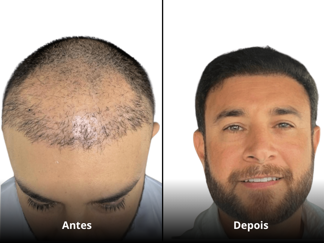 Resultado Antes e Depois