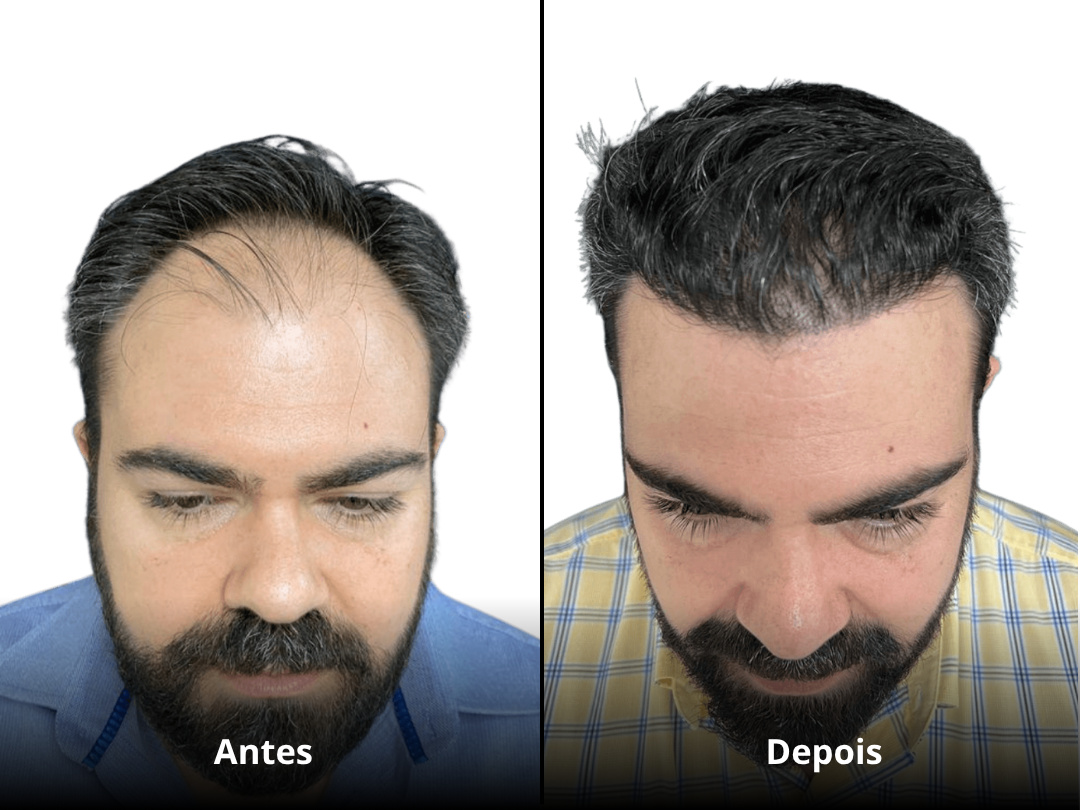 Resultado Antes e Depois