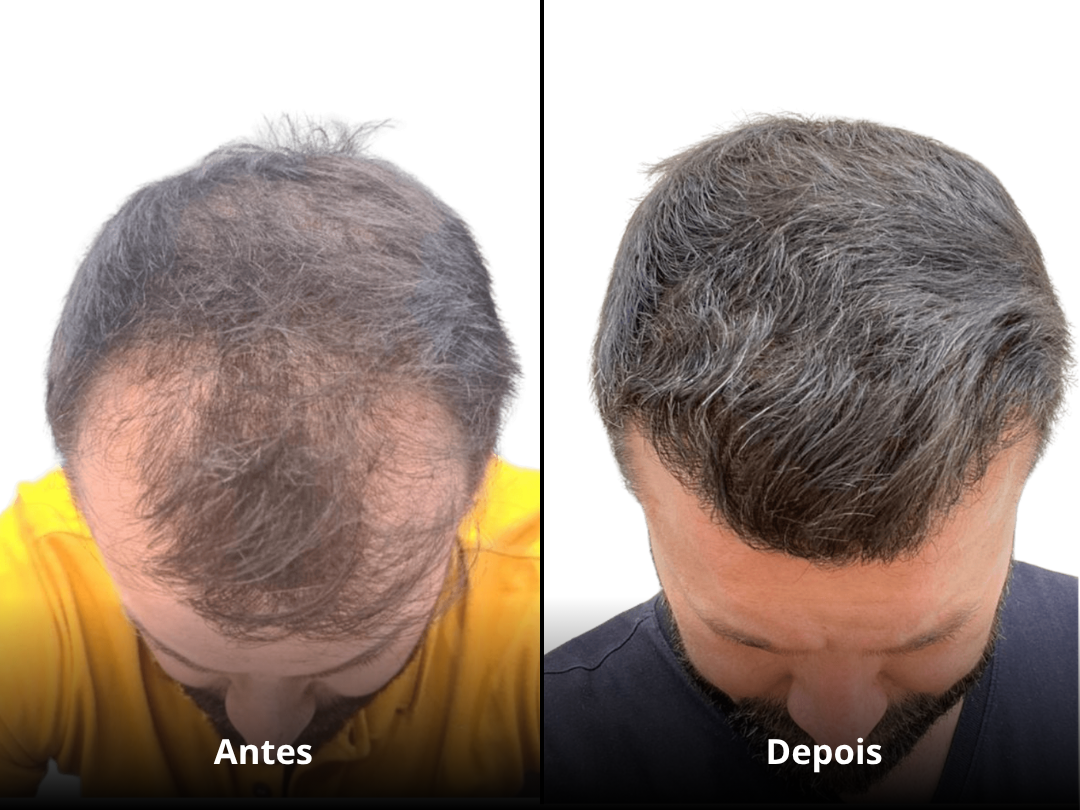 Resultado Antes e Depois